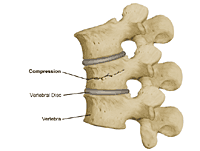 Illustration of  a compression fracture