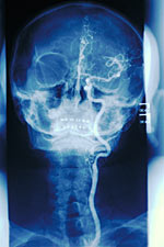 Picture of a cerebral arteriogram