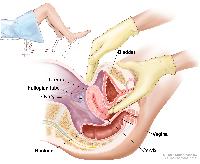 Pelvic exam; drawing shows a side view of the female reproductive anatomy during a pelvic exam. The uterus, left fallopian tube, left ovary, cervix, vagina, bladder, and rectum are shown. Two gloved fingers of one hand of the doctor or nurse are shown inserted into the vagina, while the other hand is shown pressing on the lower abdomen. The inset shows a woman covered by a drape on an exam table with her legs apart and her feet in stirrups. 