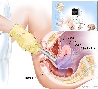 Transvaginal ultrasound; drawing shows a side view of the female reproductive anatomy during a transvaginal ultrasound procedure. An ultrasound probe (a device that makes sound waves that bounce off tissues inside the body) is shown inserted into the vagina. The bladder, uterus, right fallopian tube, and right ovary are also shown. The inset shows the diagnostic sonographer (a person trained to perform ultrasound procedures) examining a woman on a table, and a computer screen shows an image of the patient’s internal tissues.