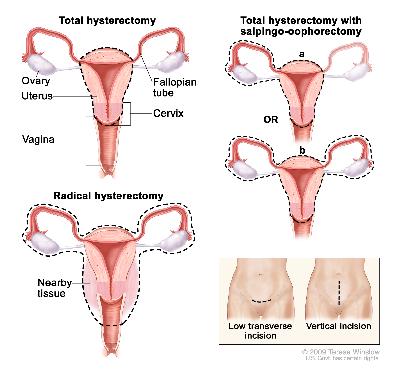 Hysterectomy; drawing shows the female reproductive anatomy, including the ovaries, uterus, vagina, fallopian tubes, and cervix. Dotted lines show which organs and tissues are removed in a total hysterectomy, a total hysterectomy with salpingo-oophorectomy, and a radical hysterectomy. An inset shows the location of two possible incisions on the abdomen: a low transverse incision is just above the pubic area and a vertical incision is between the navel and the pubic area.