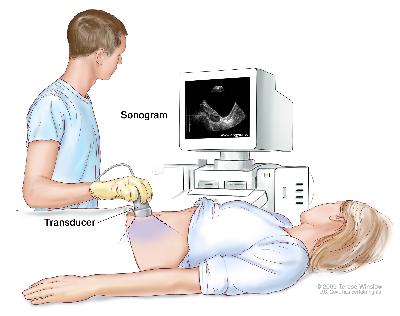 Abdominal ultrasound. An ultrasound transducer connected to a computer is passed over the surface of the abdomen. The ultrasound transducer bounces sound waves off internal organs and tissues to make echoes that form a sonogram (computer picture). Abdominal ultrasound; drawing shows a woman on an exam table during an abdominal ultrasound procedure. A diagnostic sonographer (a person trained to perform ultrasound procedures) is shown passing a transducer (a device that makes sound waves that bounce off tissues inside the body) over the surface of the patient’s abdomen. A computer screen shows a sonogram (computer picture).