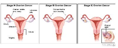 Three-panel drawing of stage IA, IB, and IC ovarian cancer; first panel shows a stage IA tumor inside one ovary. The second panel shows two stage IB tumors, one inside each ovary. The third panel shows two stage IC tumors, one inside each ovary, and one tumor has a ruptured capsule. An inset shows cancer cells floating in the peritoneal fluid surrounding abdominal organs. Also shown are the fallopian tubes, uterus, cervix, and vagina.
