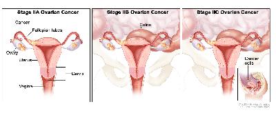 Three-panel drawing of stage IIA, IIB, and IIC ovarian cancer; first panel shows two stage IIA tumors, one inside each ovary, that have spread to the uterus and fallopian tube. The second panel shows two stage IIB tumors, one inside each ovary, that have spread to the uterus, fallopian tube, and colon. The third panel shows two stage IIC tumors, one inside each ovary, that have spread to the uterus and colon. An inset shows cancer cells floating in the peritoneal fluid surrounding abdominal organs. Also shown are the cervix and vagina.