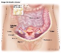 Stage IIIA ovarian cancer; drawing shows tumors inside both ovaries that have spread to the uterus, colon, and the surface of the peritoneum. Also shown are the fallopian tubes, small intestine, and bladder.