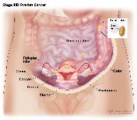 Stage IIIB ovarian cancer; drawing shows tumors inside both ovaries that have spread to the uterus, colon, small intestine, and the peritoneum, where they are 2 centimeters or smaller in diameter. An inset shows 2 centimeters is about the size of a peanut. Also shown are the fallopian tubes and bladder.