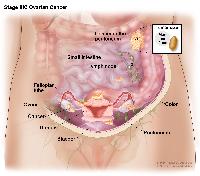 Stage IIIC ovarian cancer; drawing shows tumors inside both ovaries that have spread to the uterus, colon, small intestine, lymph nodes in the abdomen, and the surface of the peritoneum, where they are larger than 2 centimeters in diameter. An inset shows 2 centimeters is about the size of a peanut. Also shown are the fallopian tubes and bladder.