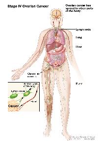 Stage IV ovarian cancer; drawing shows parts of the body where ovarian cancer may spread, including the liver, lung, lymph nodes, and bone. An inset shows a close-up of cancer spreading through the blood and lymph to other parts of the body.
