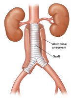 Graft Repair of Abdominal Aneurysm