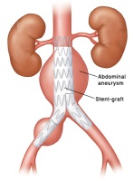 Stent Graft Repair of Abdominal Aneurysm