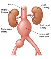 Infrarenal Aneurysm