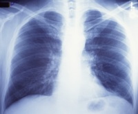 Chest X-ray