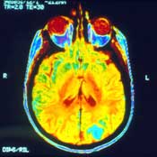 mri