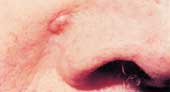 cell carcinoma