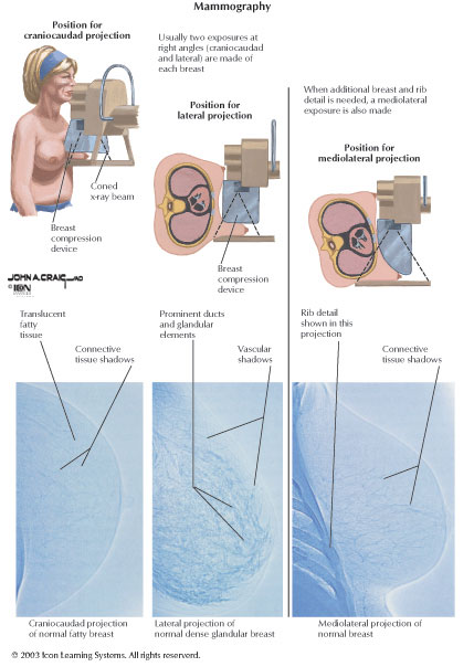 Mammography mammography