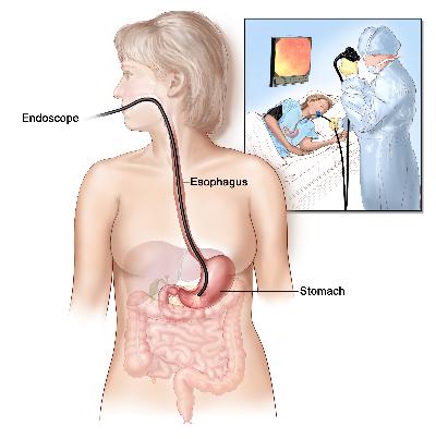Upper endoscopy. A thin, lighted tube is inserted through the mouth to look for abnormal areas in the esophagus, stomach, and first part of the small intestine. Upper endoscopy; shows endoscope inserted through the mouth and esophagus and into the stomach. Inset shows patient on table having an upper endoscopy.