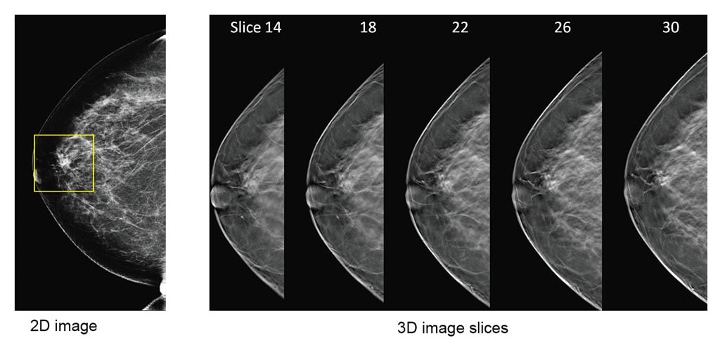 2d vs 3d mammography comparison