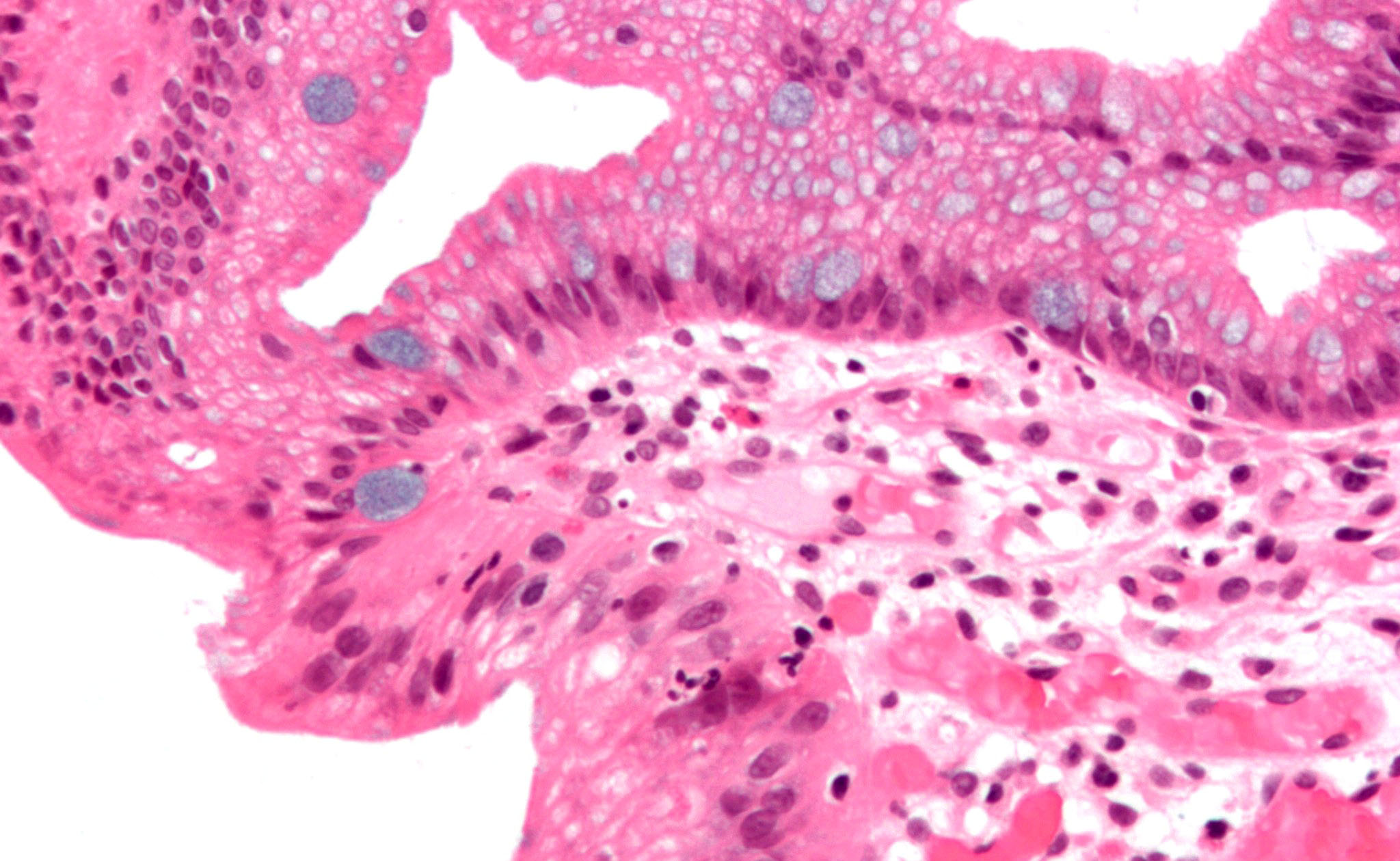 High-magnification micrograph of Barrett's esophagus showing the characteristic goblet cells.