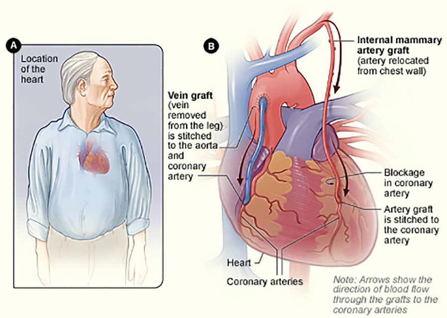 CABG infographic