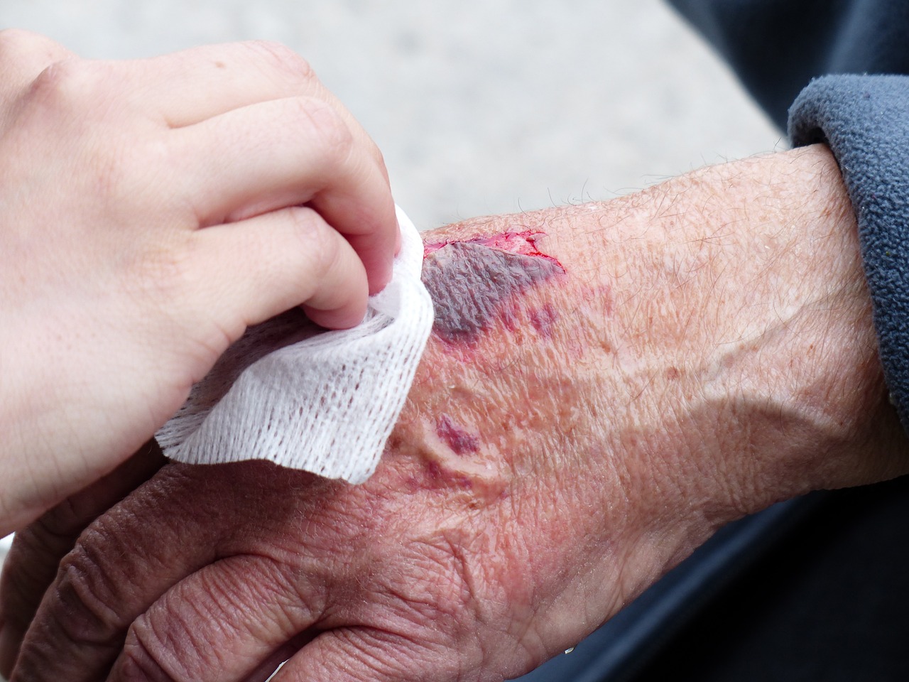 hand-357889_1280 Wound care of lesion on elderly hand