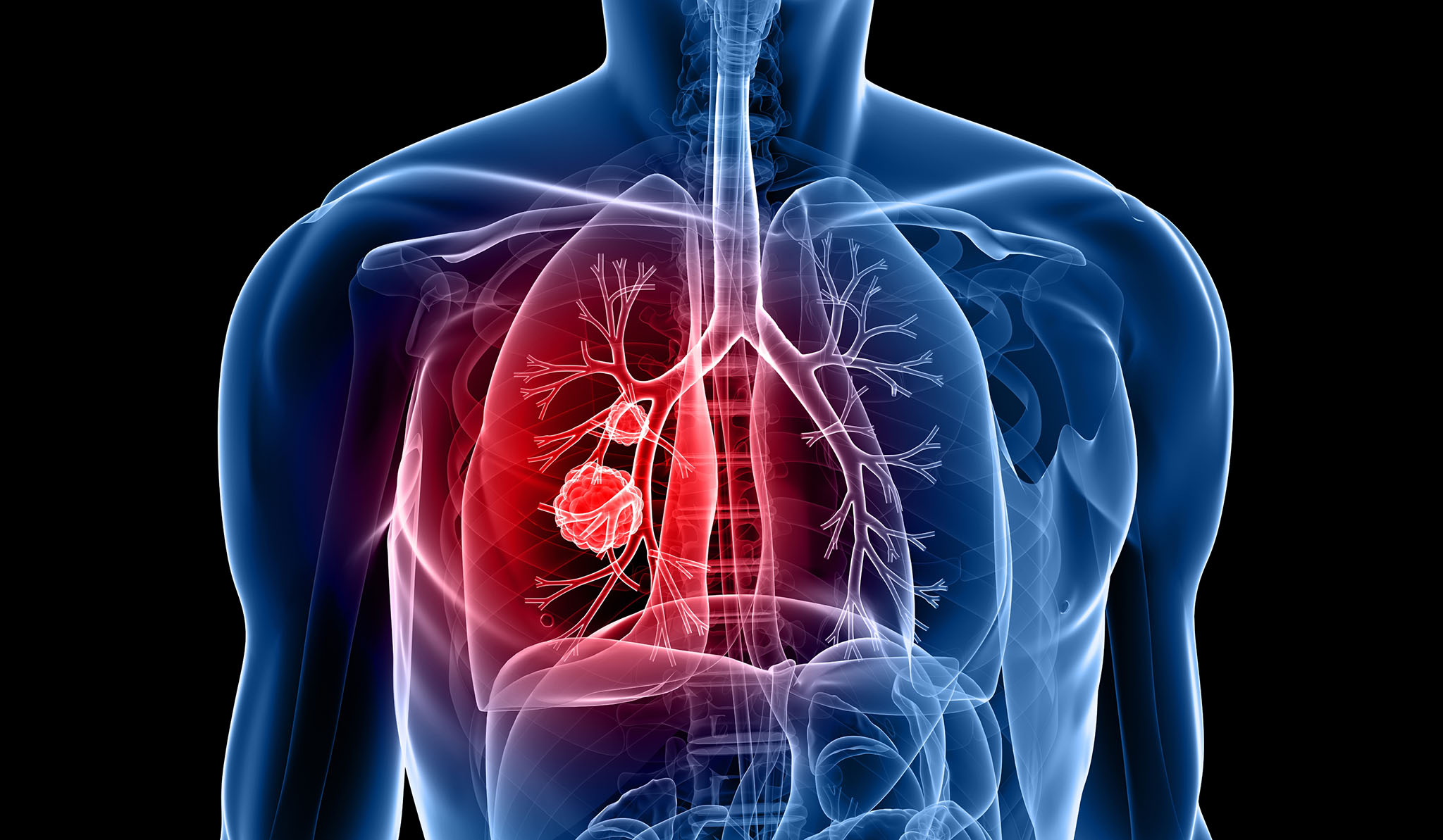 Lung Cancer illustration