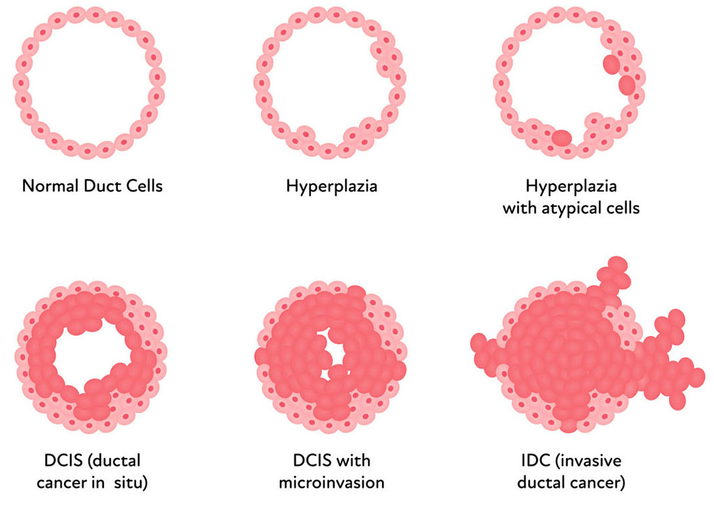 Illustration showing breast duct cell types ranging from normal, hyperplasia, and invasive ductal cancer.