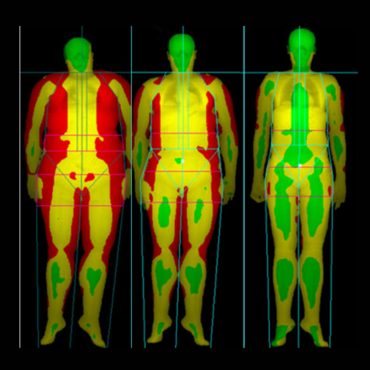 Illustrating showing results of a DEXA bone density scan for three different body types.