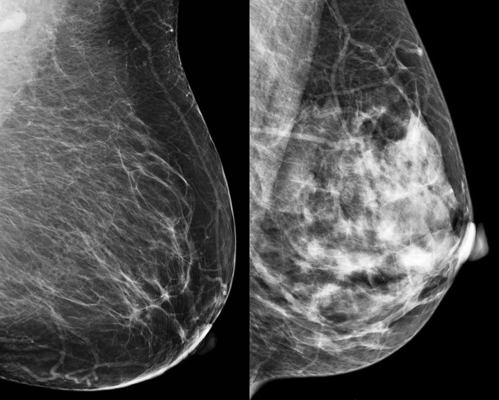 Mammogram showing comparison of fatty breast vs dense breast.