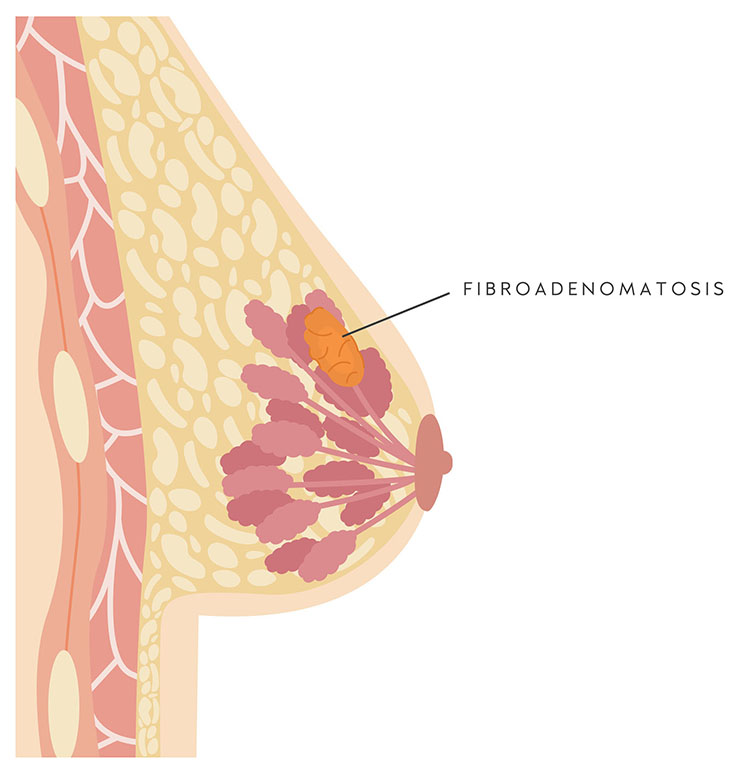 Illustration showing fibroadenomatosis in a breast.
