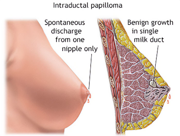 Illustration showing cross section of breast with benign growth in single milk duct found in Intraductal Papilloma.