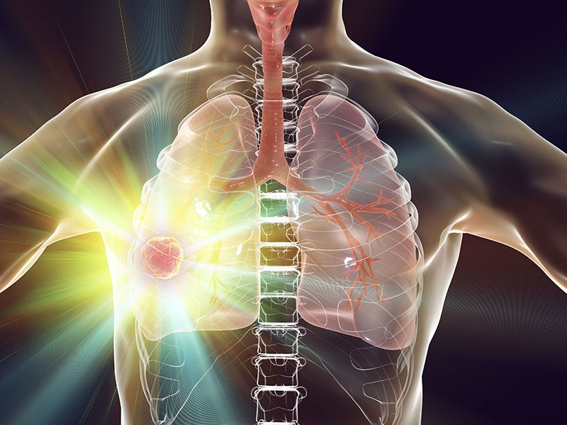 Lung cancer treatment