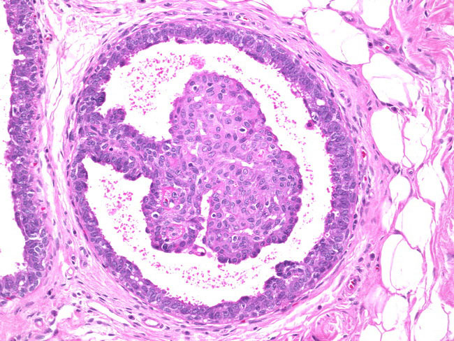 Papillomatosis as viewed through a microscope.