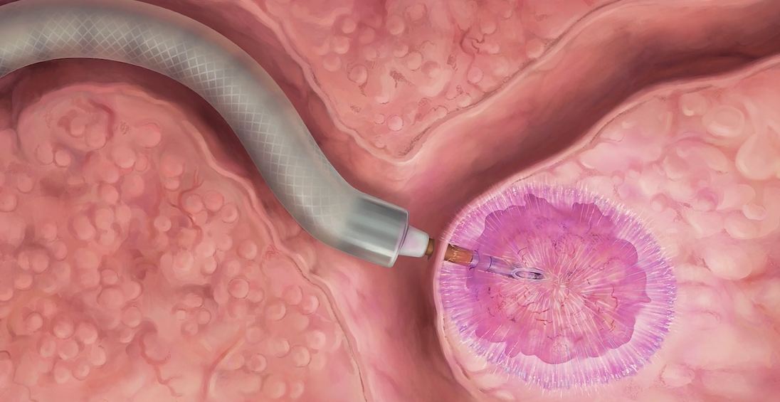 PEF ablation for lung cancer.