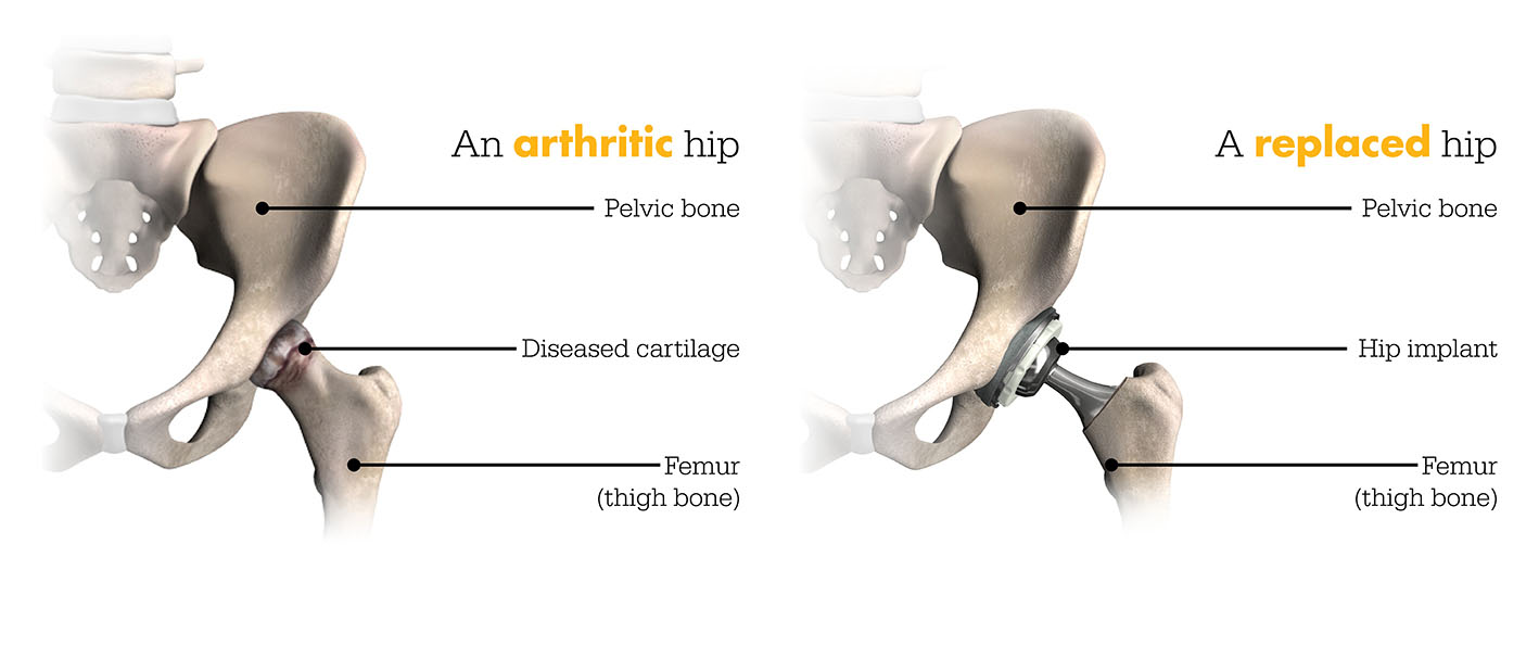 Illustration of an arthritic hip vs a replaced hip following surgery.