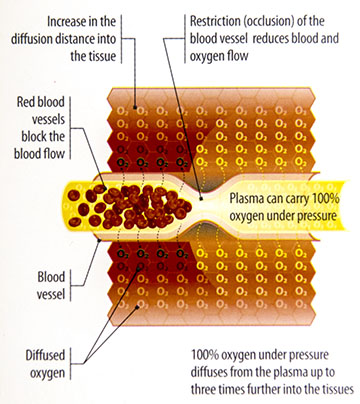 Hyperbaric Oygen Therapy oygentation graphic