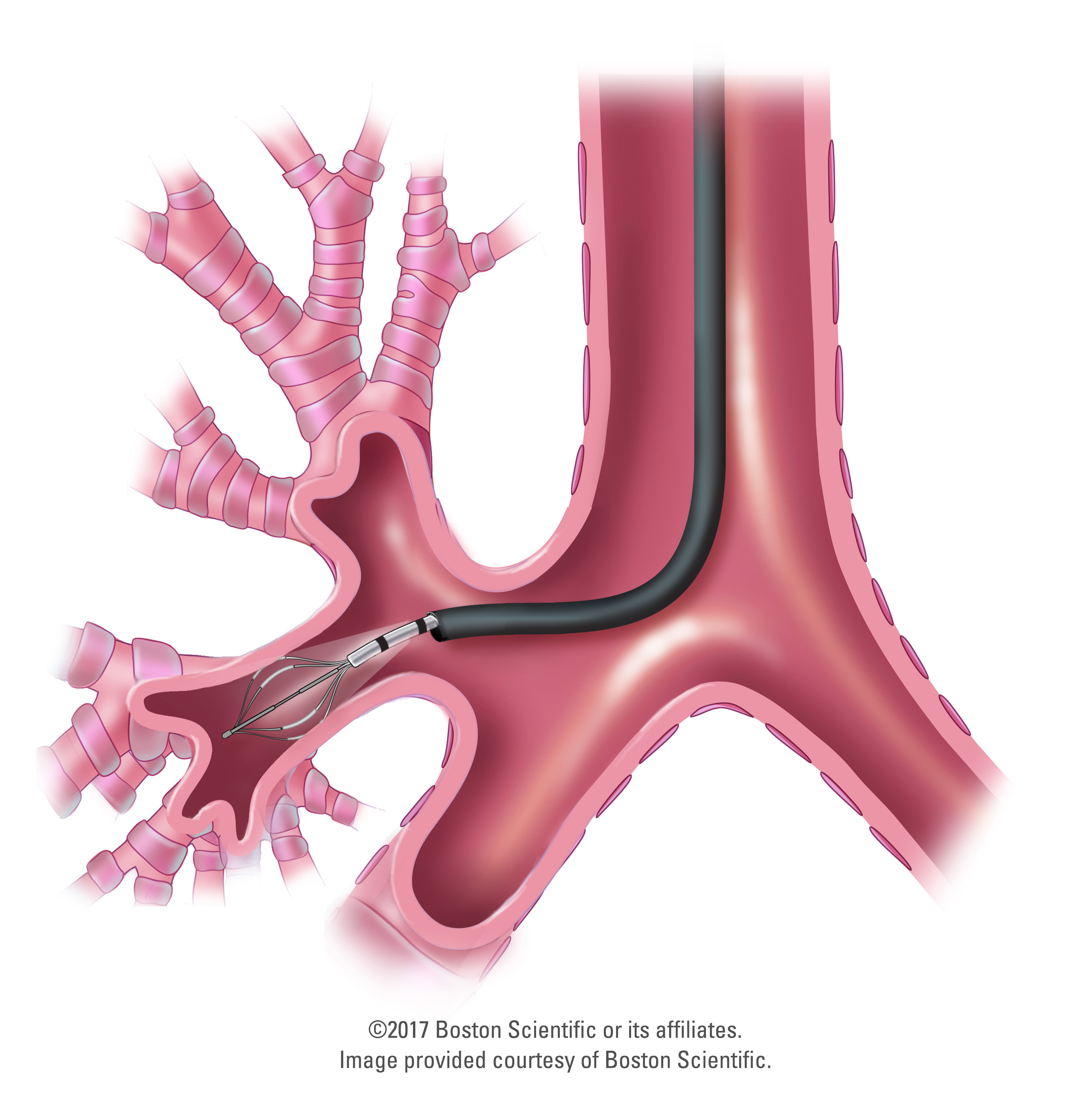 Bronchial Thermoplasty illustration