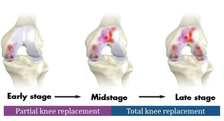 Illustration showing partial knee replacement vs total knee replacement.