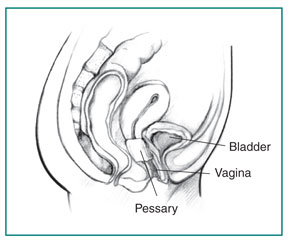 Cystocele -  Pessary insert