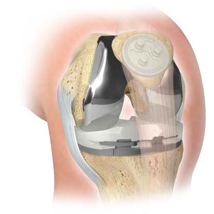 Example of a total knee replacement
