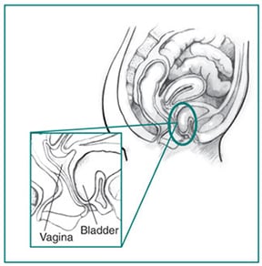 Cystocele Cystocele present, which may require prolapsed bladder surgery
