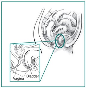 Cystocele present, which may require prolapsed bladder surgery