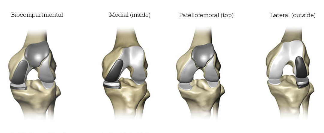 knee replacement surgery types