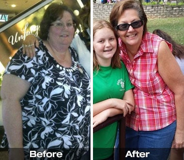 Lisa P. before and after sleeve gastrectomy.