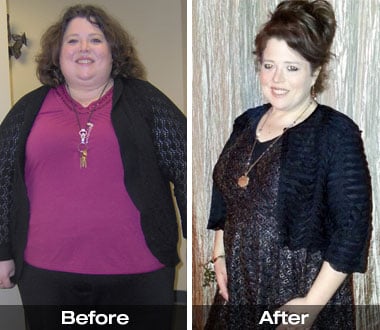 Stacy P. before and after gastric sleeve bypass surgery.