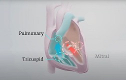 Aortic valve stenosis illustration