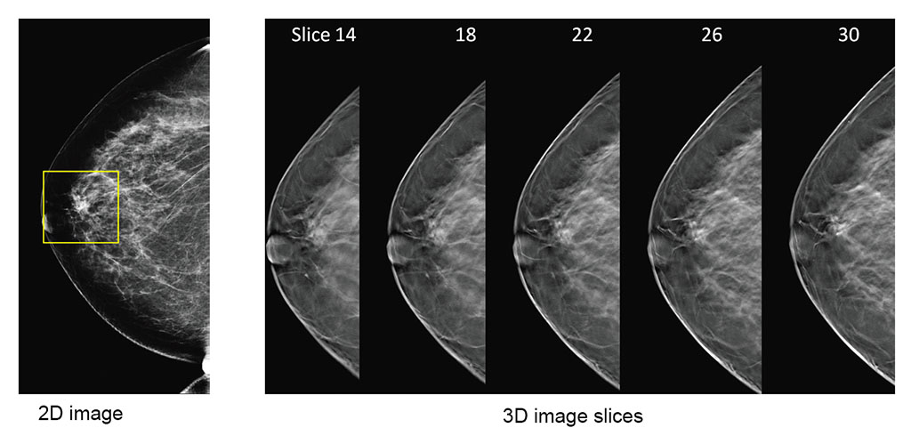 2d-vs-3d-mammography-comparison