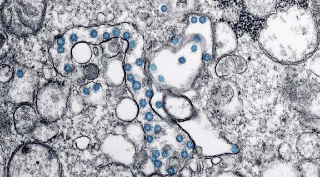 Coronavirus as seen through a microscope.