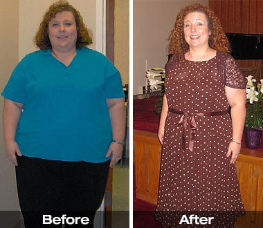 Angie C. before and after bariatric surgery.