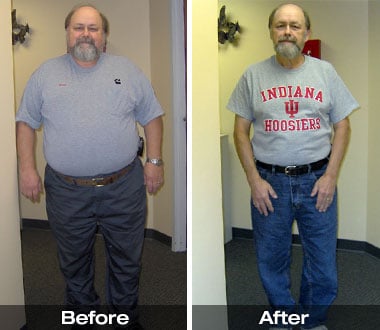 Bruce F. before and after Roux-en-Y gastric bypass surgery.