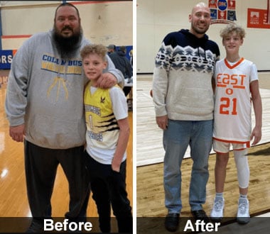 Corey S. before and after medically-supervised weight loss and sleeve gastrectomy.